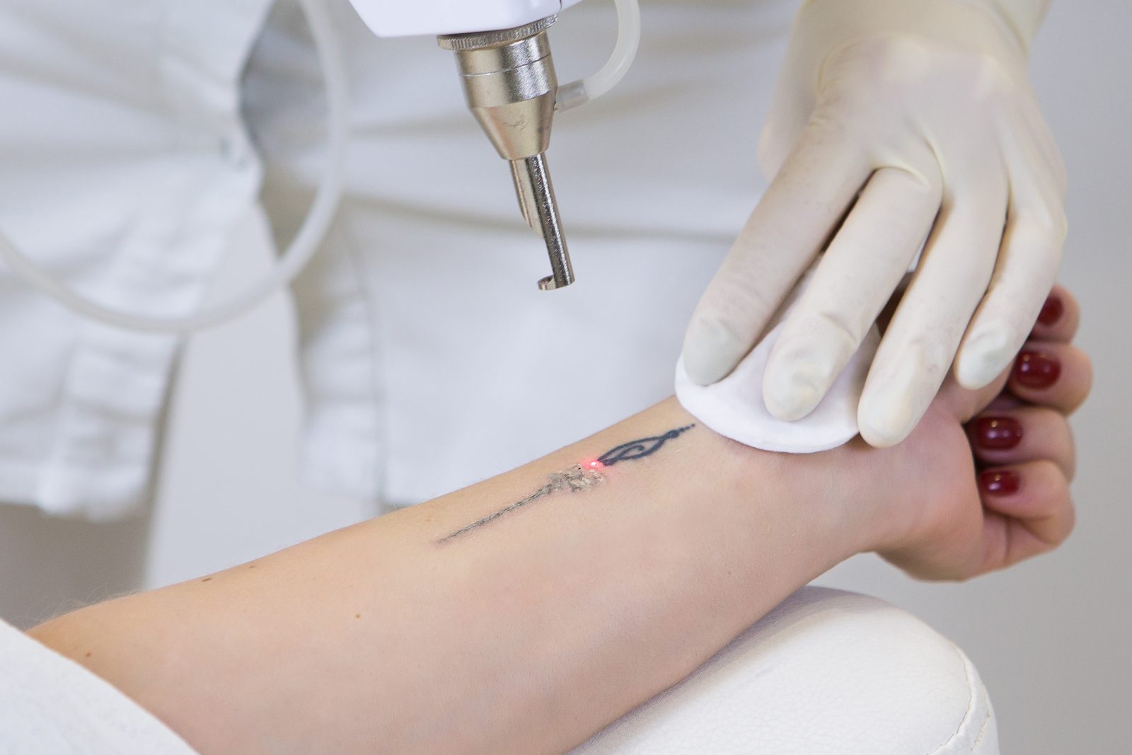 Pico Laser for Tattoo Removal: How It Works & Results