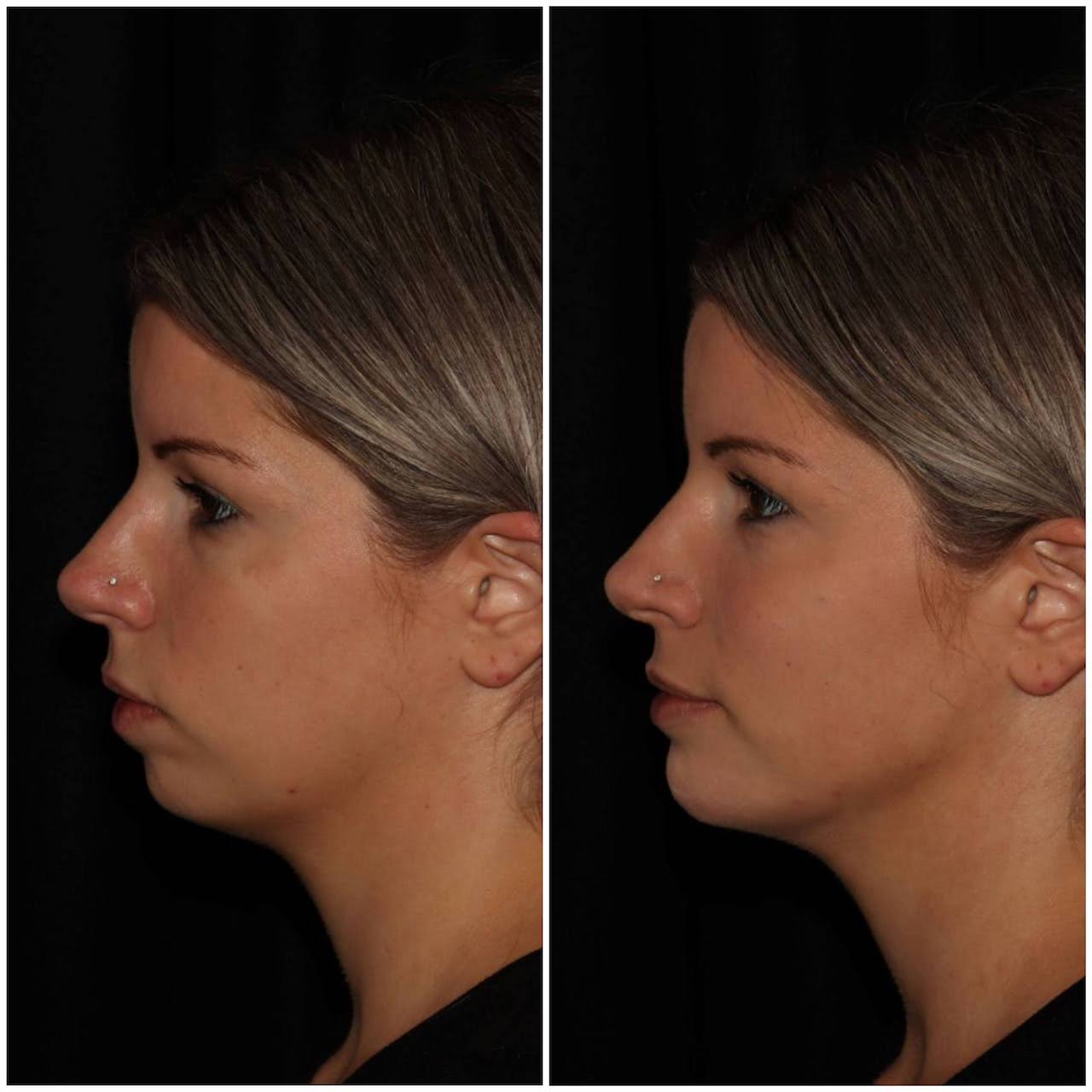 Skin Injectables Under Eye Filler Vancouver Laser