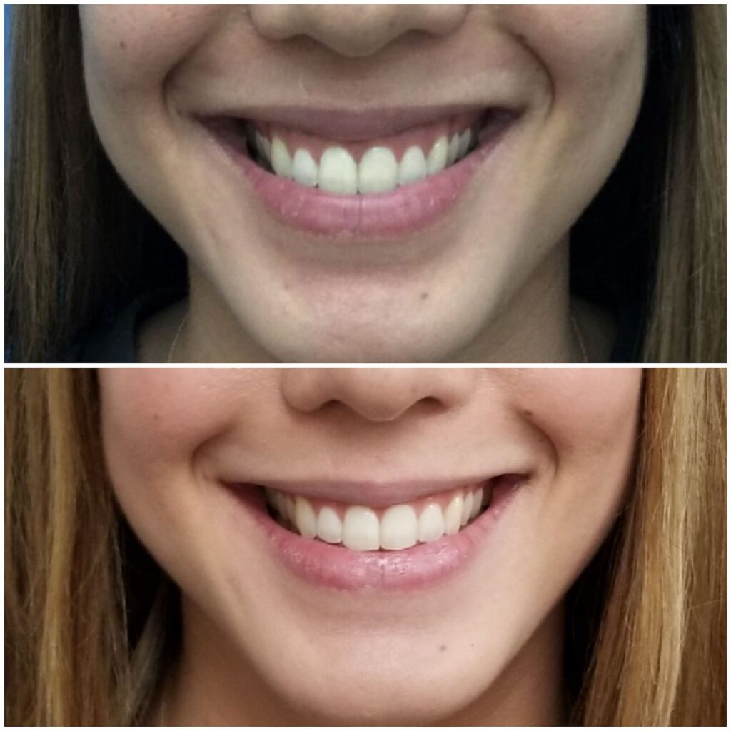 Skin Injectables Under Eye Filler Vancouver Laser