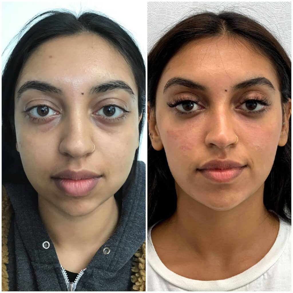 Skin Injectables Under Eye Filler Vancouver Laser