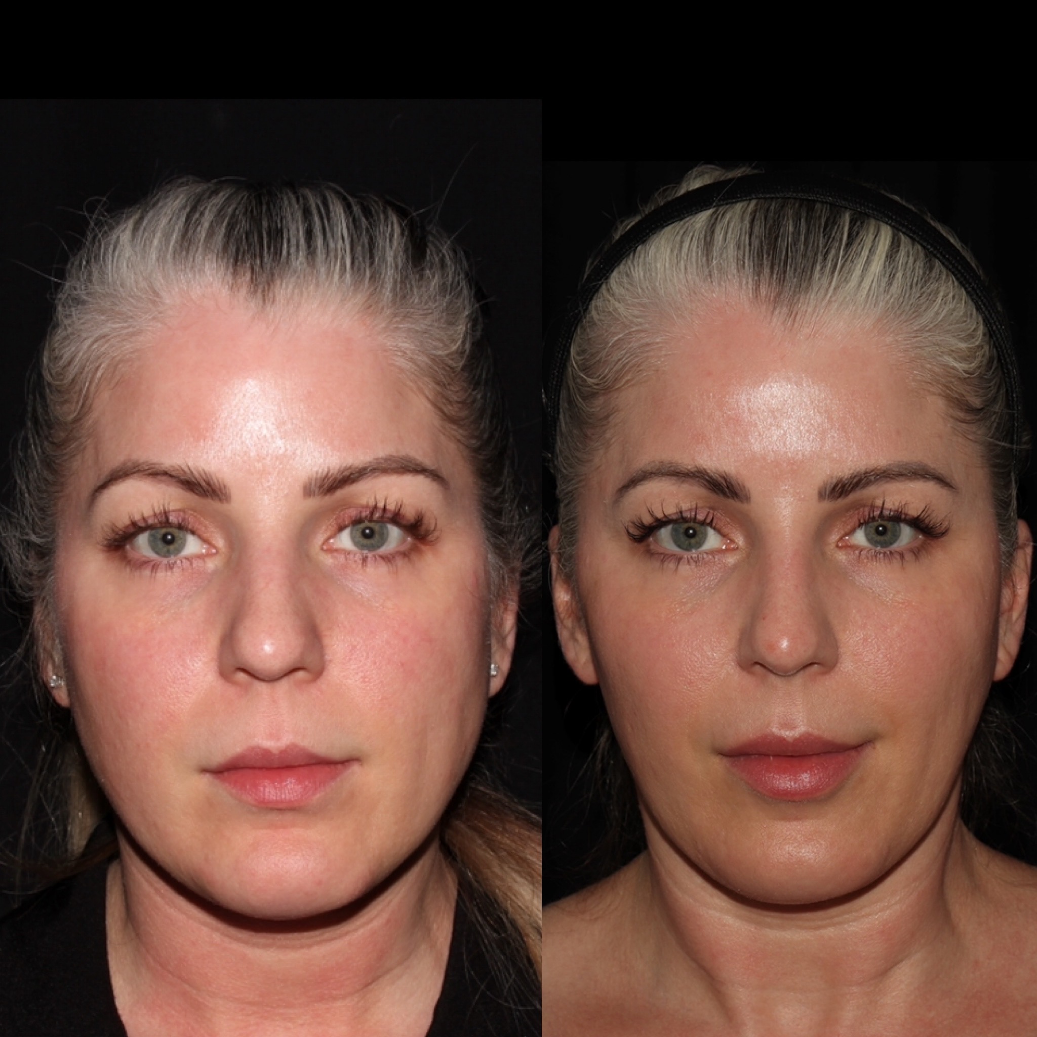 Skin Injectables Under Eye Filler Vancouver Laser