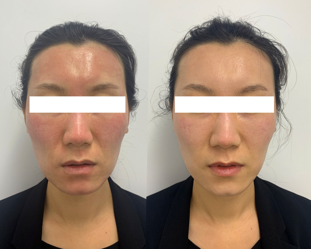 Immediate Post Care Vancouver Laser & Skin Care Centre