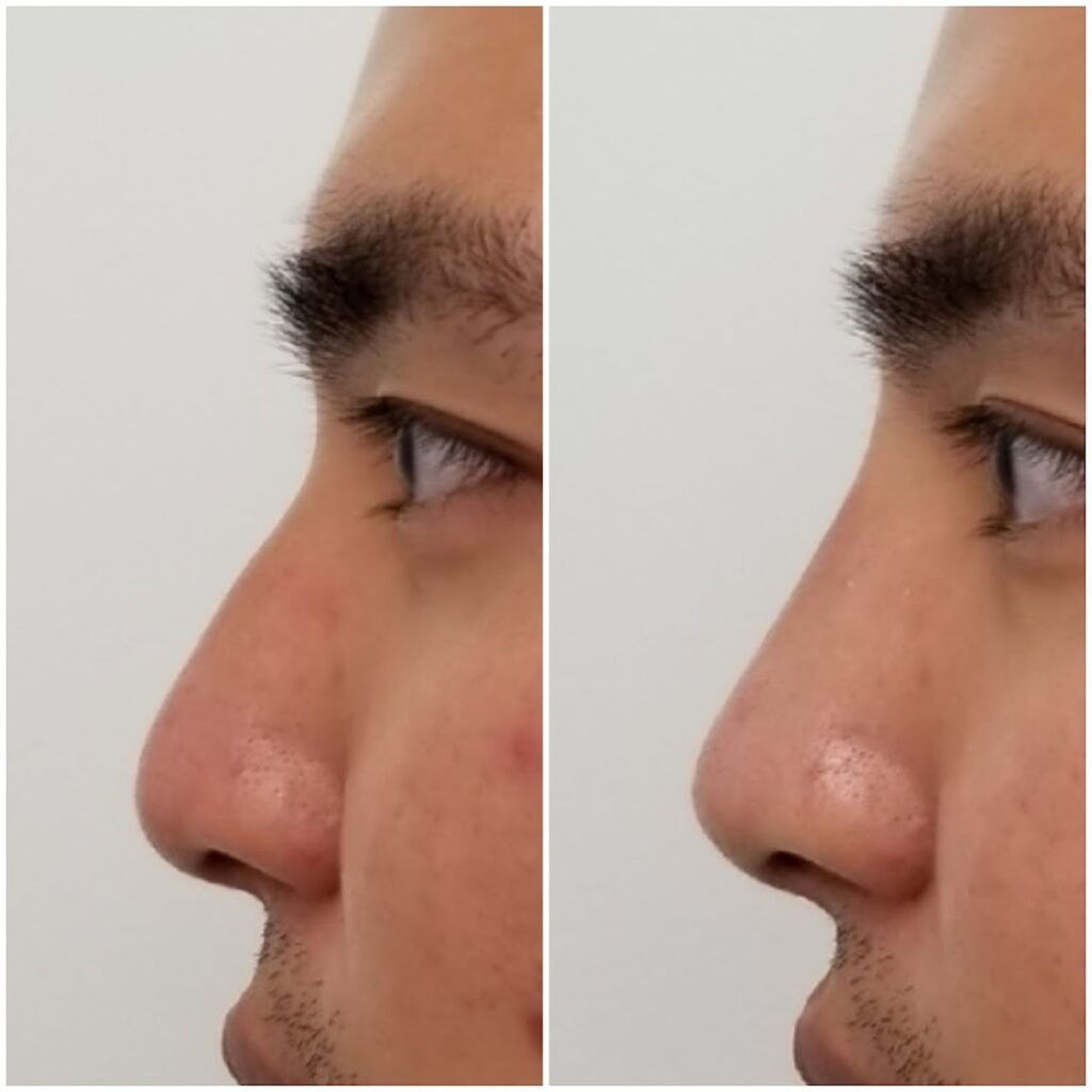 Skin Injectables Under Eye Filler Vancouver Laser