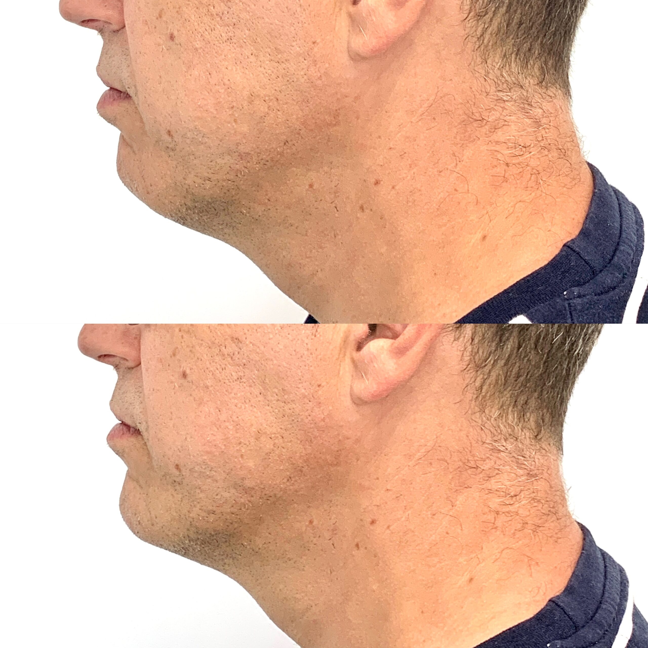 Skin Injectables Under Eye Filler Vancouver Laser