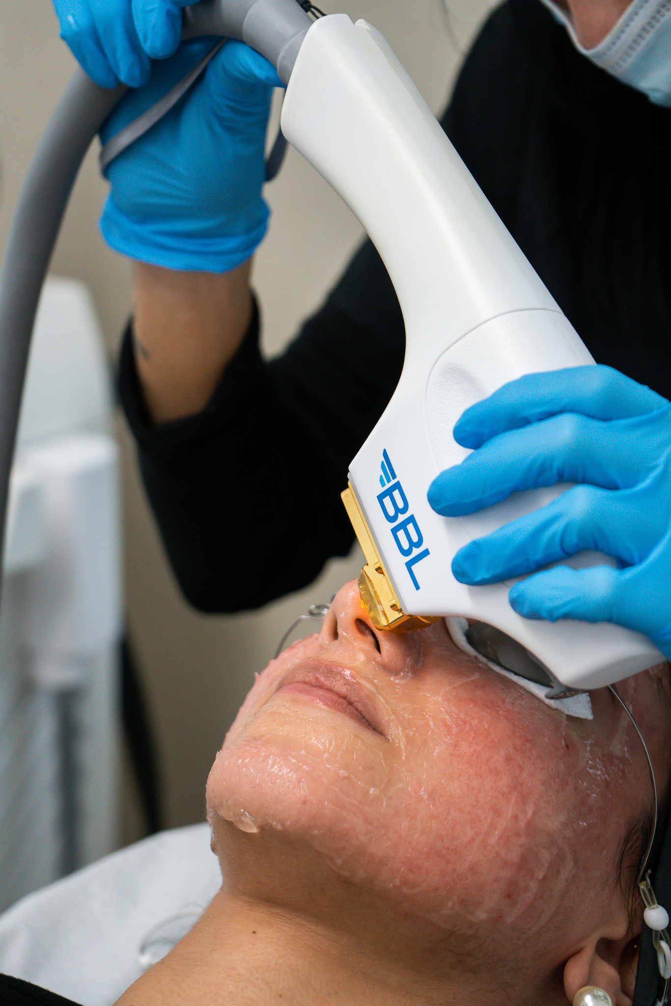 BBL™ BroadBand Light Vancouver Laser & Skin Care Centre