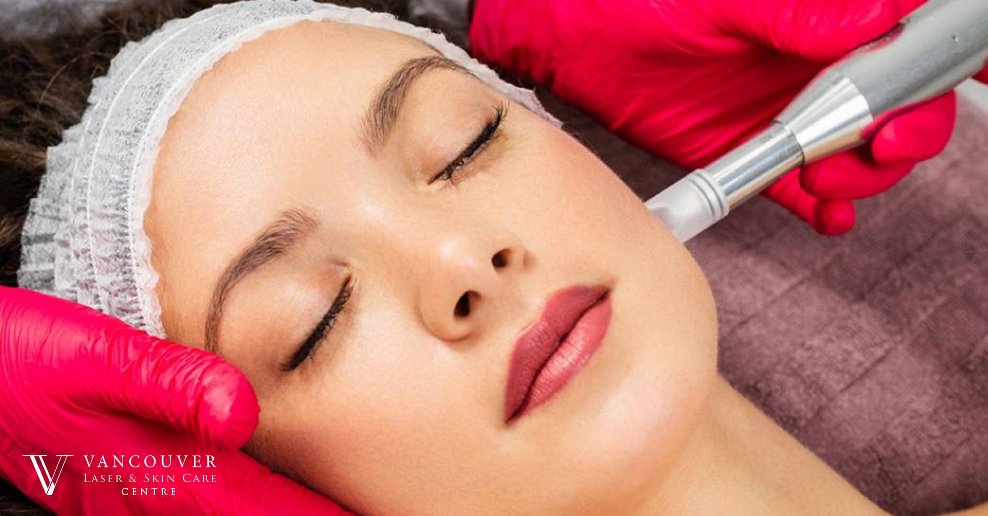 Scars healed after microneedling