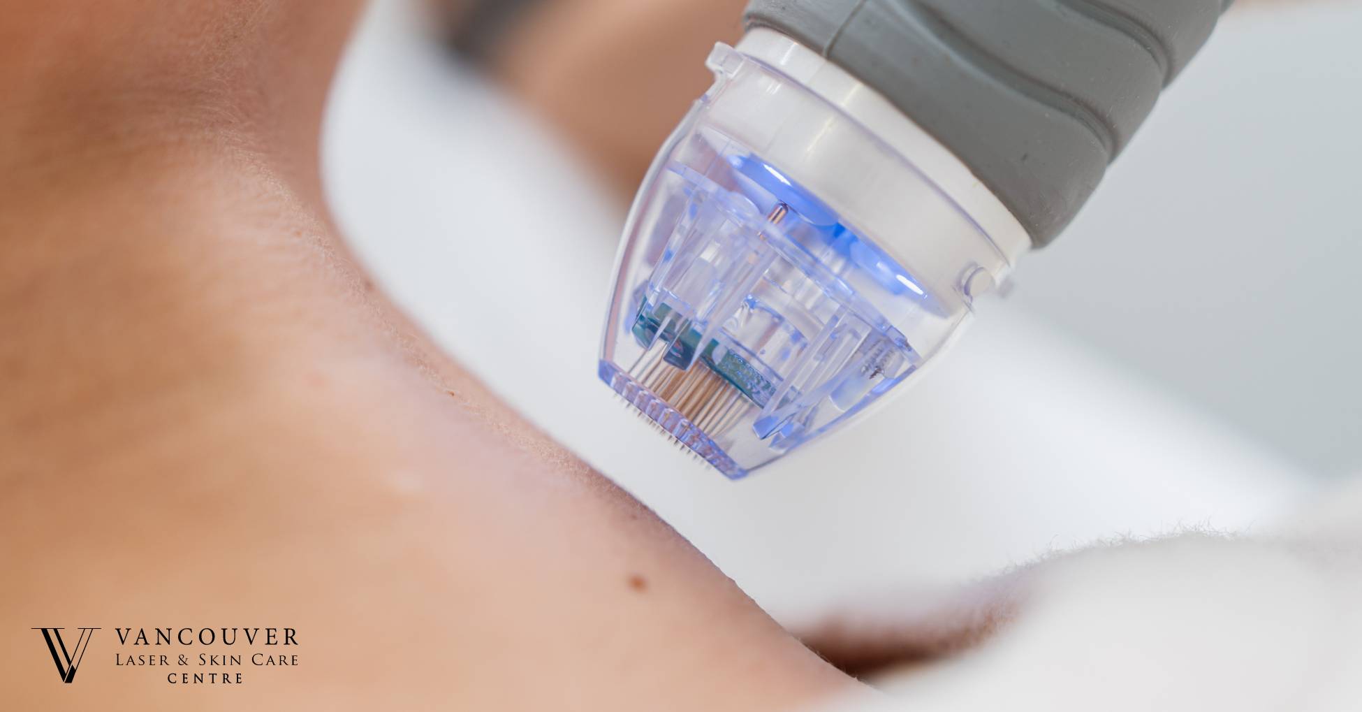 Results of microneedling
