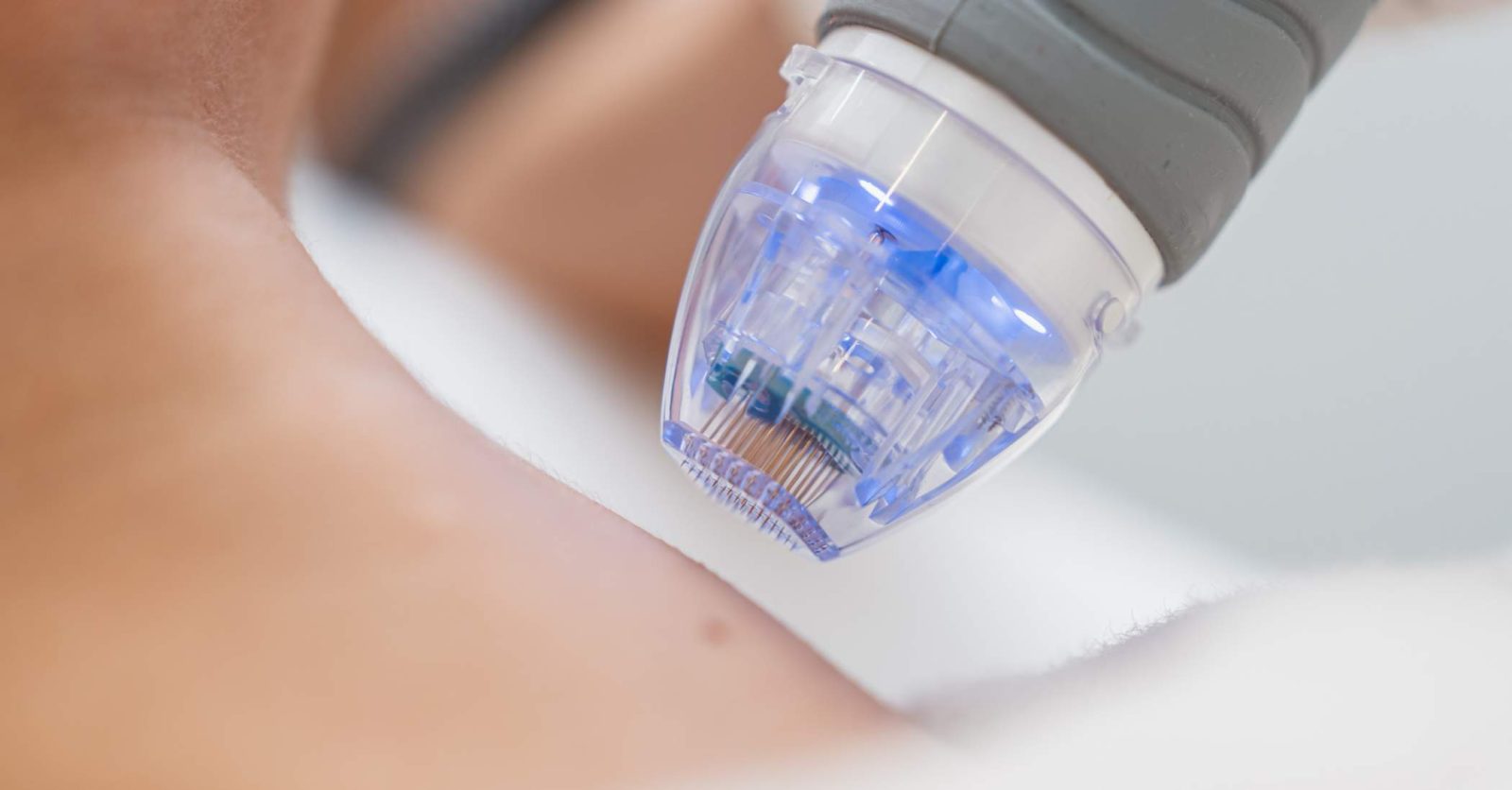 What Does Microneedling Do