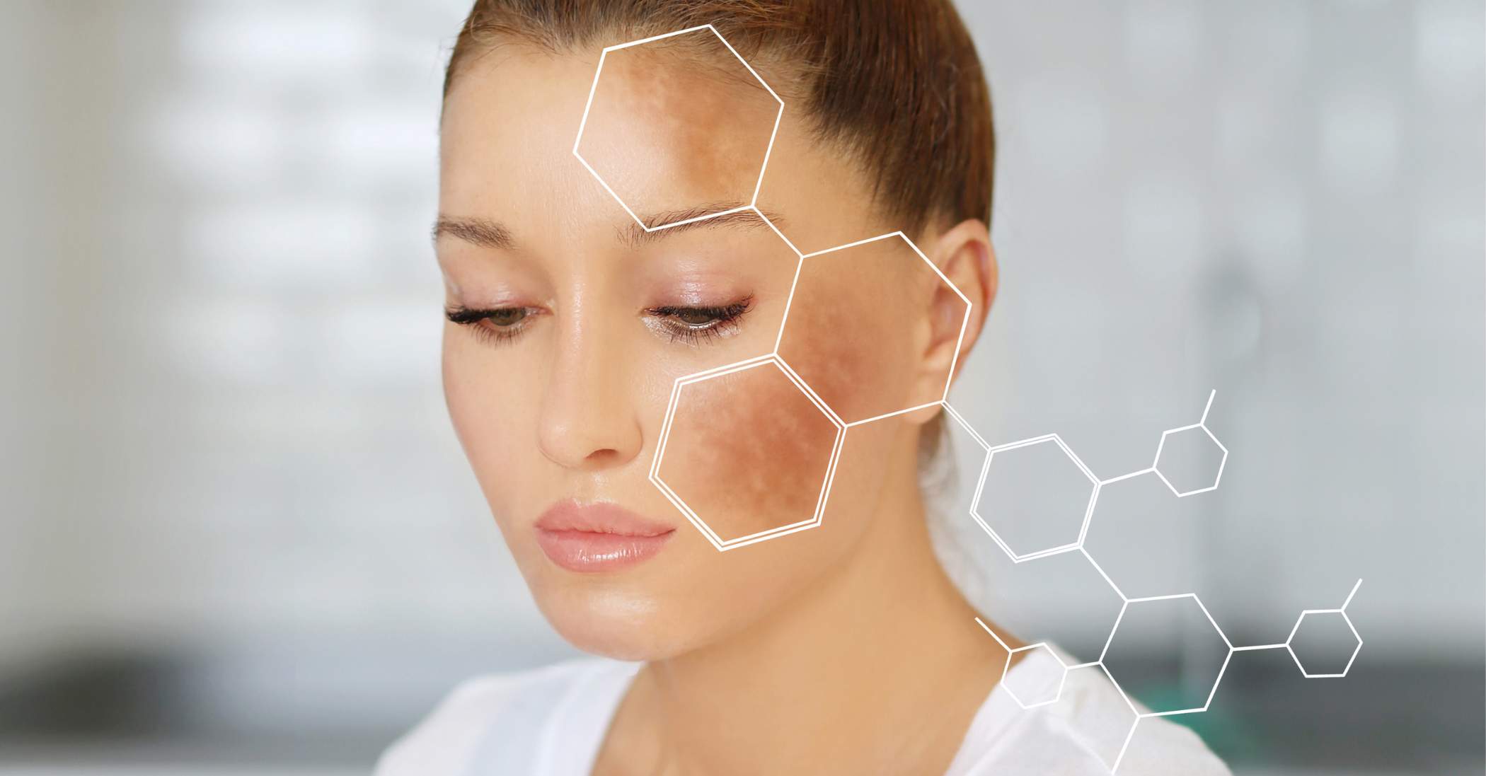 Best Treatments for Facial Melasma