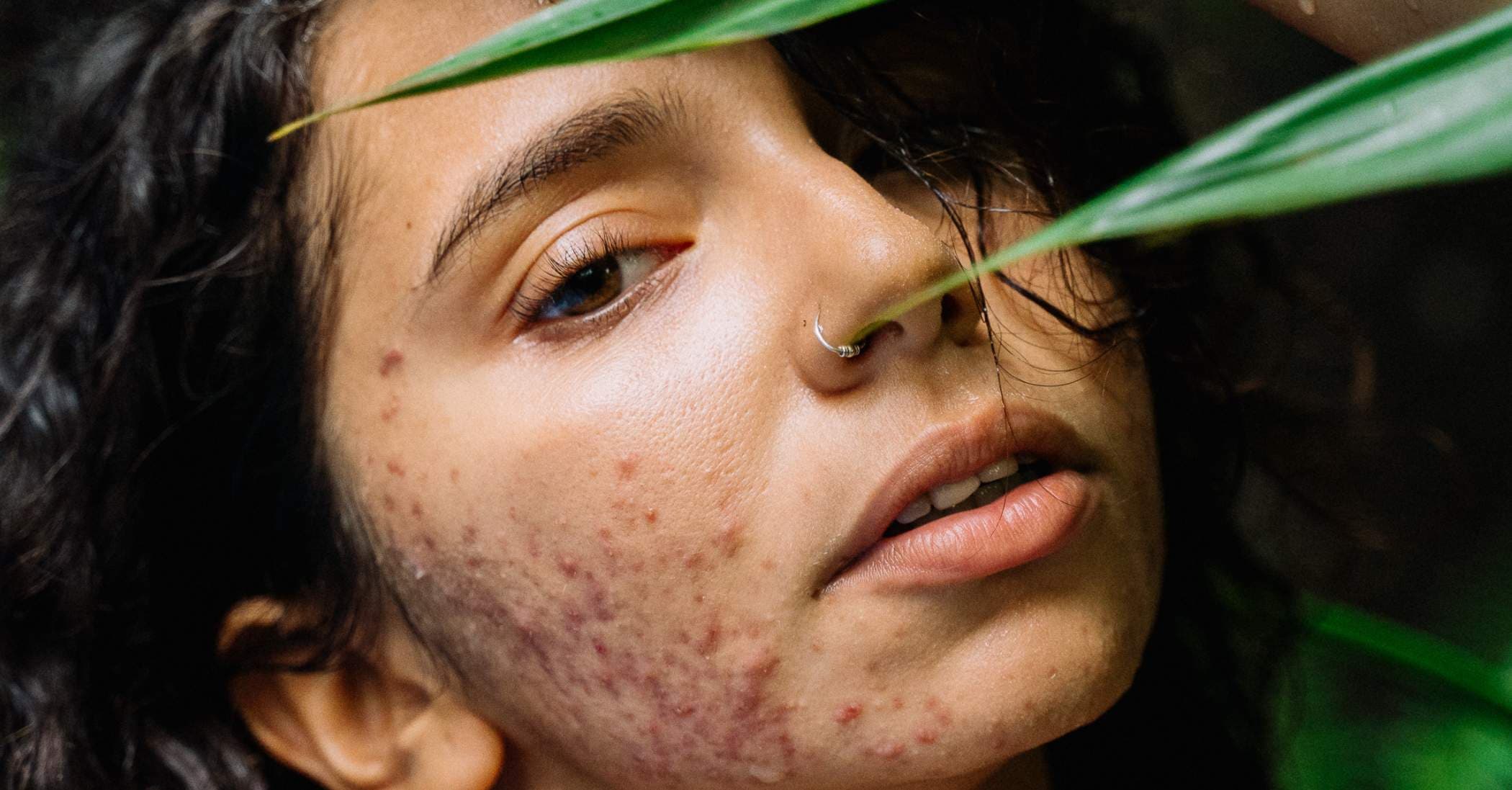 Cystic Acne: Causes, Treatments, and How to Manage It