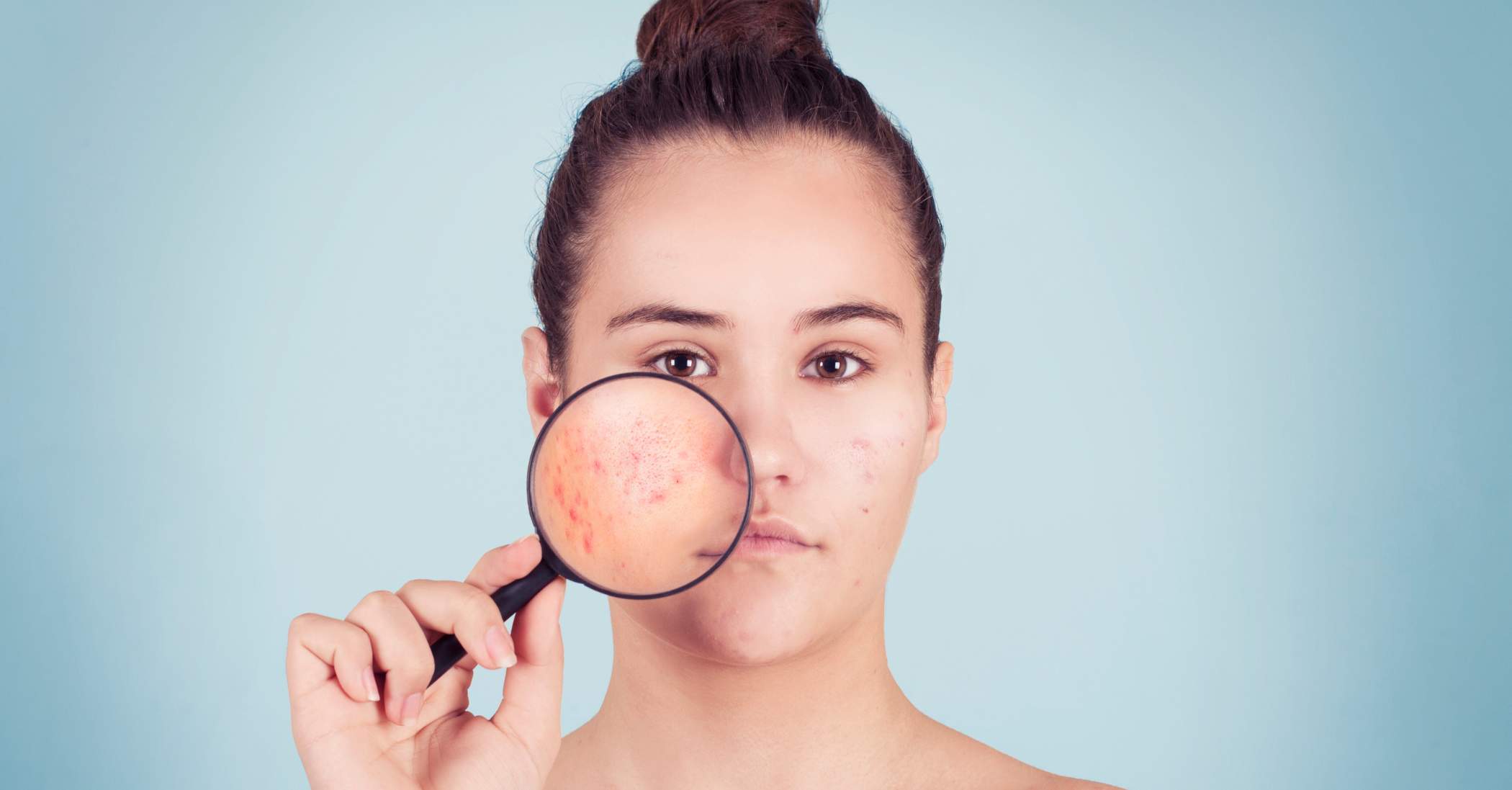 Hormonal Acne What It Is