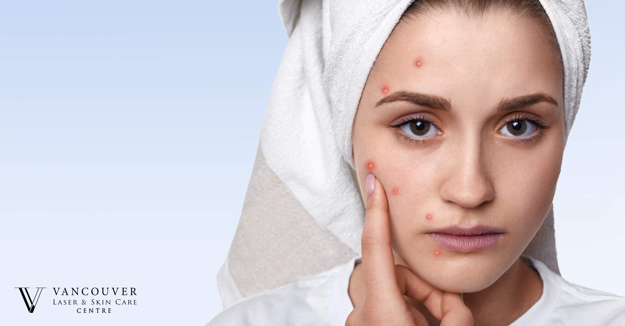 Professional Treatment for Cystic Acne
