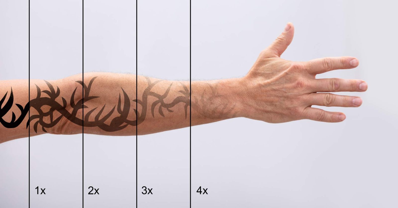 Want to Remove Your Tattoo? Here's the Laser Solution