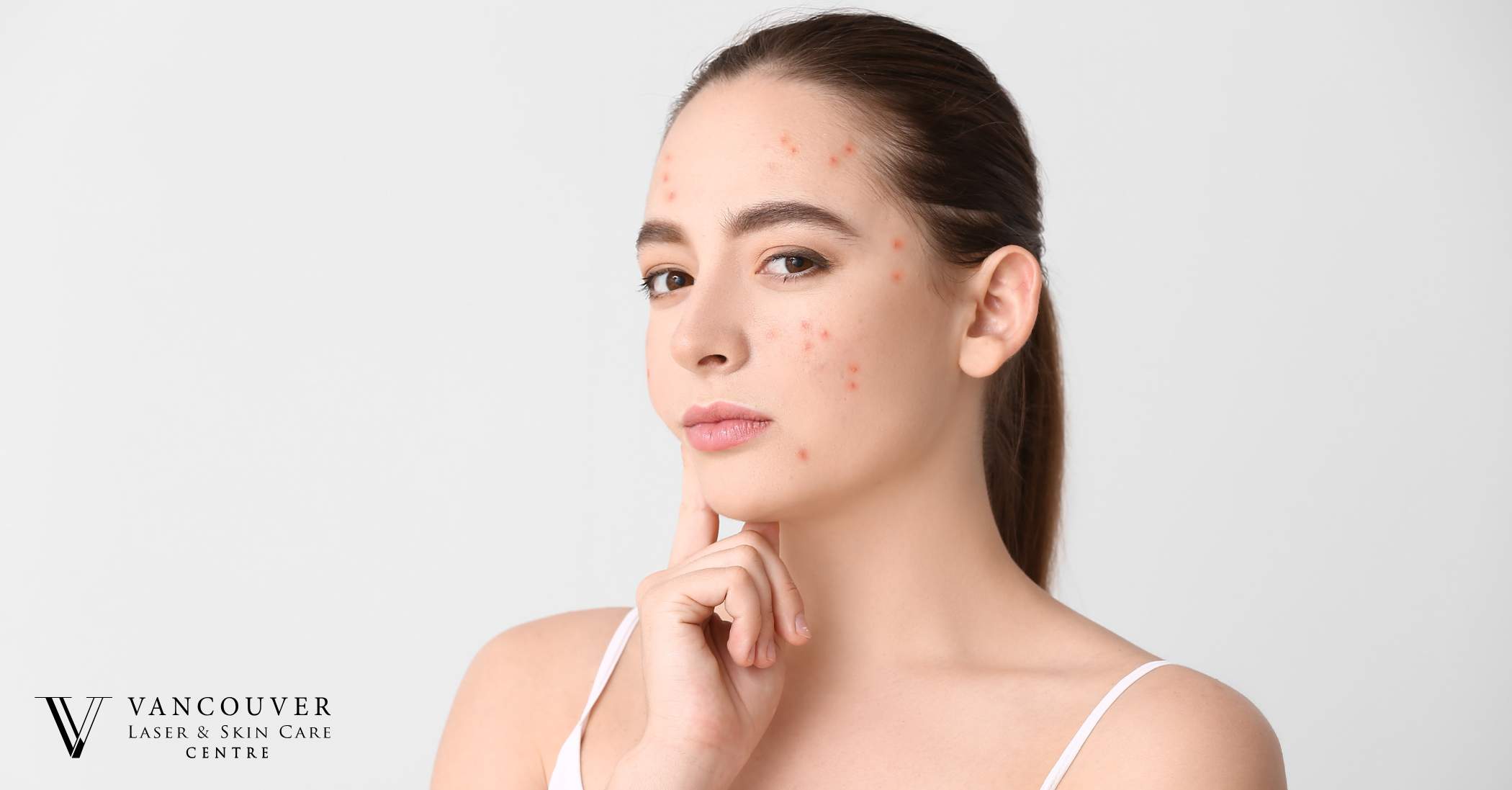 What causes acne