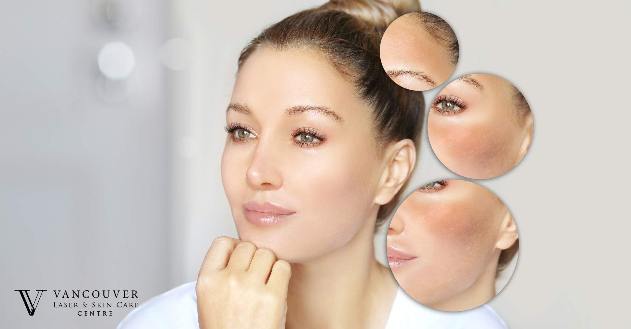 Best treatment for Melasma