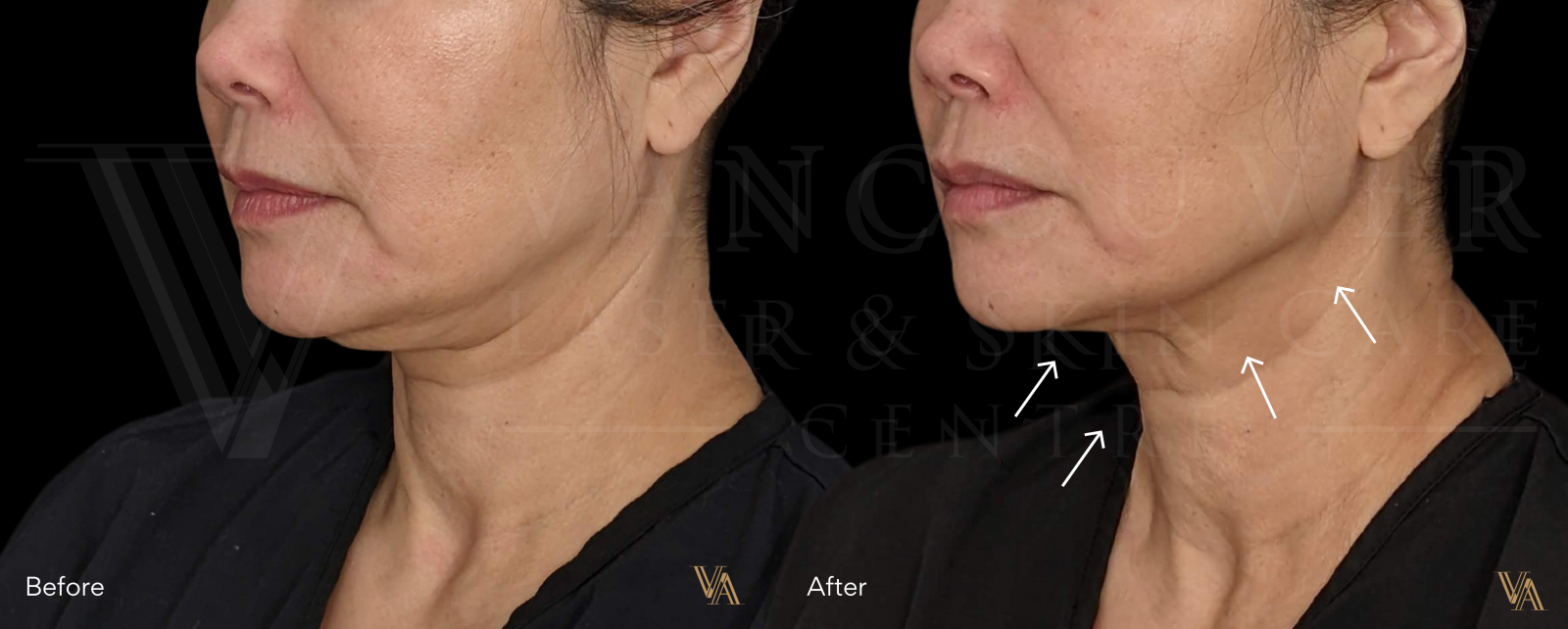 facelift