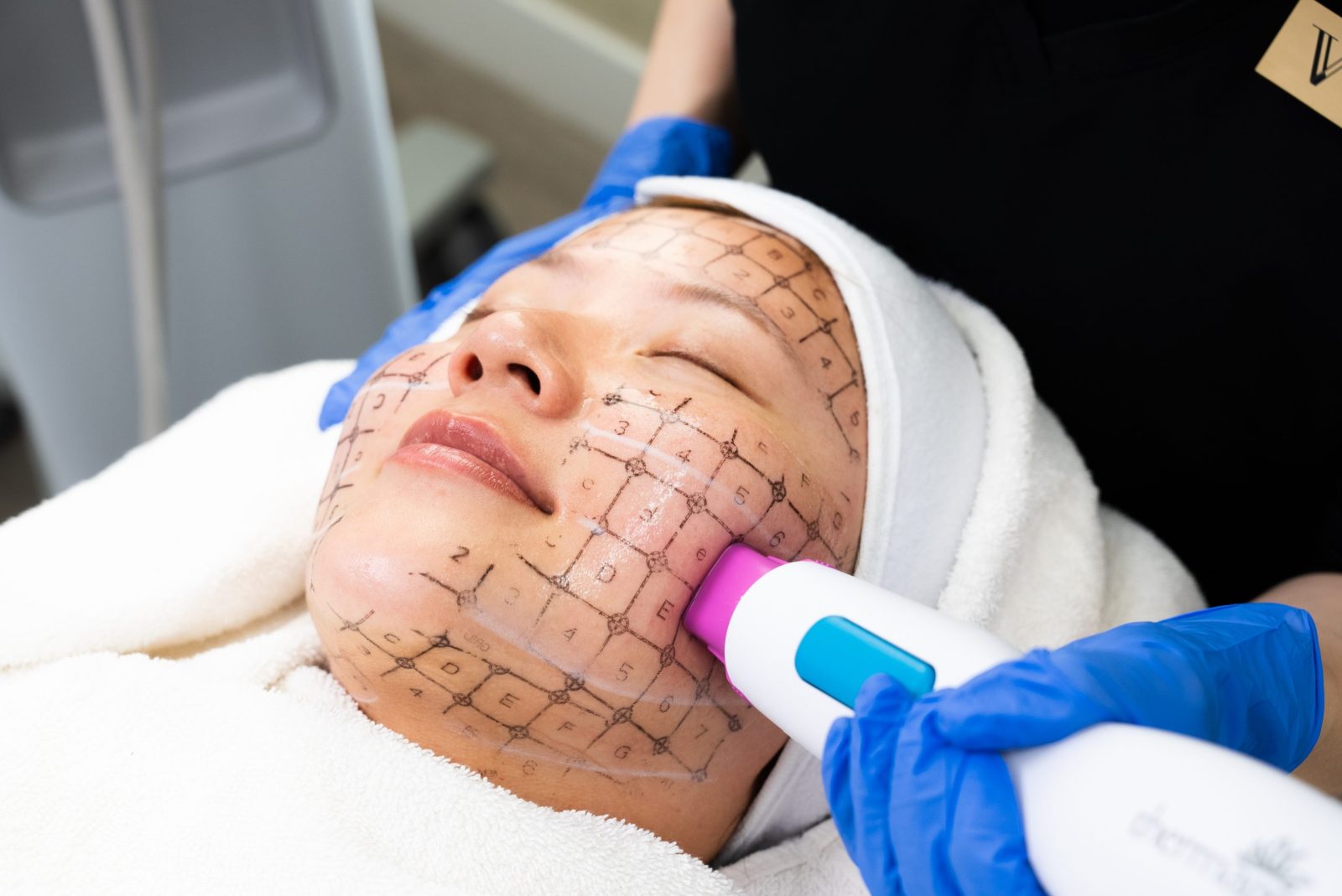 thermage flx at vancouver laser