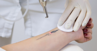 Tattoo Removal
