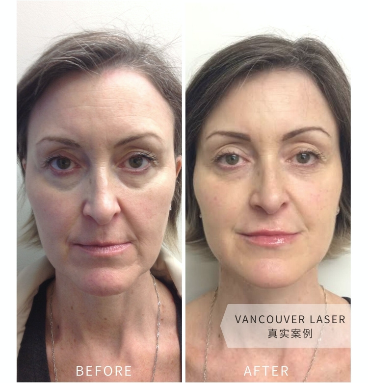 Vancouver Laser玻尿酸微调前后对比